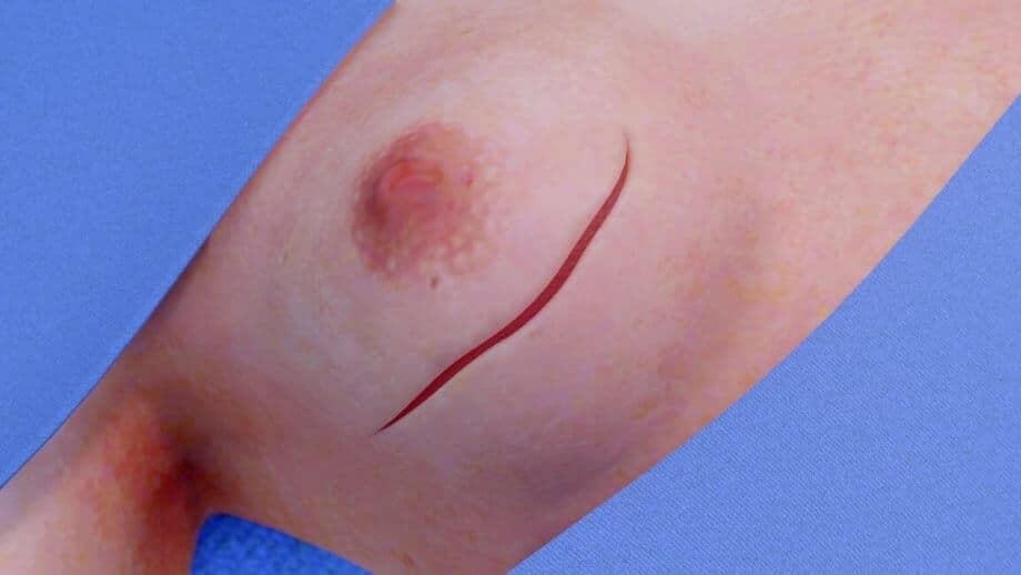 Failed Breast Implant Surgery